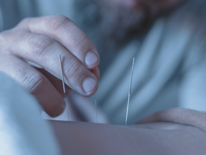 Acupuntura suportamed manejo de dolor quimioterapia
